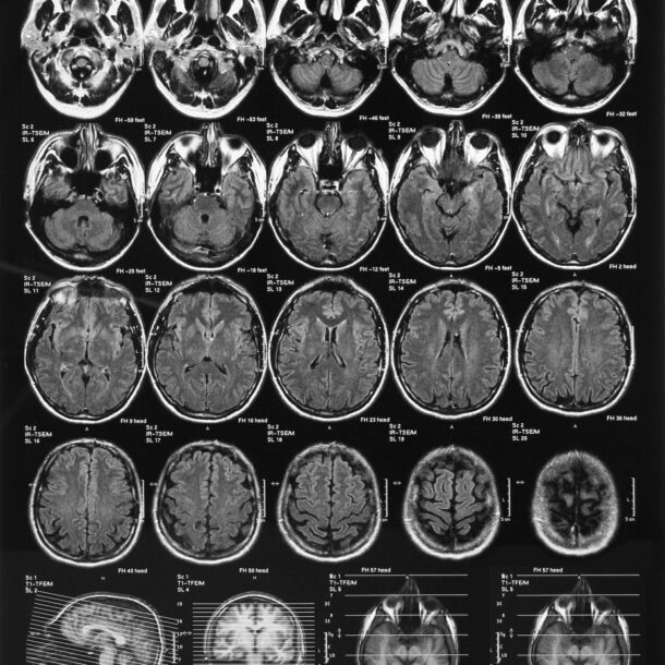 X-ray film of the brain computed tomography.