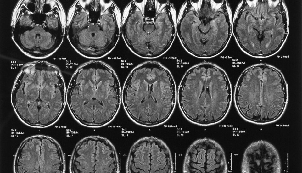 X-ray film of the brain computed tomography.